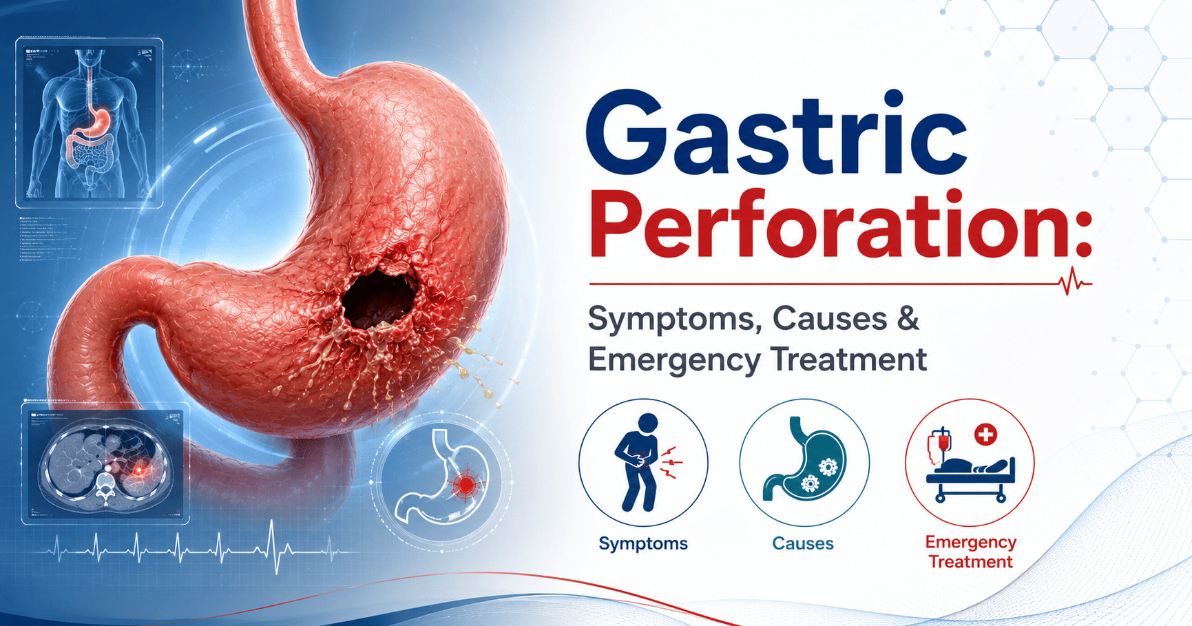 Gastric Perforation Symptoms, Causes & Emergency Treatment